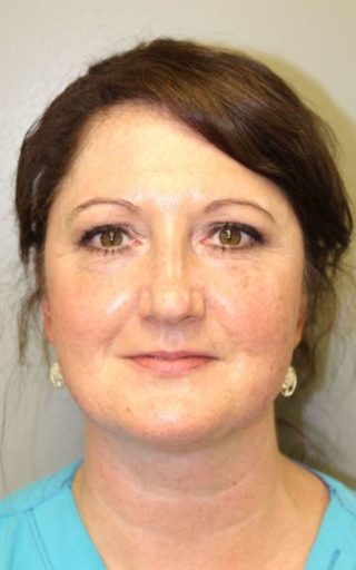 CoolPeel_After-Treatment-Image-Nease