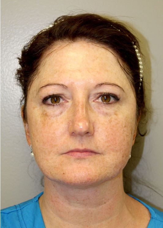 CoolPeel_Before-Treatment-Image-Nease