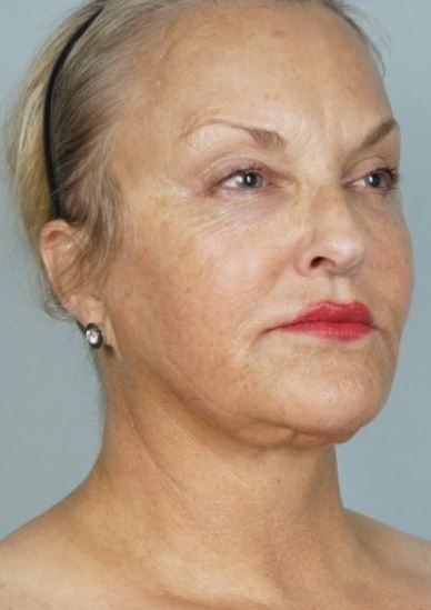 CoolPeel_Before-Treatment-Image_Petti